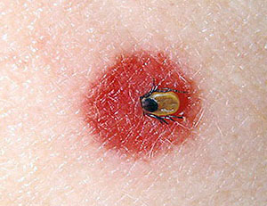 borrelia_burgdorferi_2